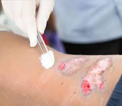 Contact dermatitis on the face. Dealing With Irritant Contact Dermatitis Medical Adhesives