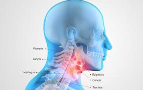 During radiotherapy, the energy beams are do you know? Warning Signs Of Throat Cancer You Should Know