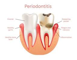 Try one of these home remedies to help relieve your swollen gums: Periodontal Disease Causes Symptoms And Treatment Dentalrave