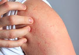 Image result for Notalgia Paresthetica