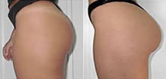 Bonjour je voudrais faire une lipofilling au niveau des fessiers. Augmentation Fesses Tunisie Prix Pose Implant Fessier Pas Cher