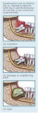 Impacted Wisdom Teeth Signs Of Trouble Impacted Wisdom Teeth Wisdom Teeth Dental Hospital