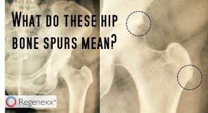 Bone Spur Pain Why Relief May Be Simpler Than You Think