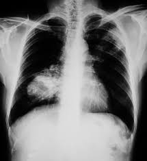 The computer puts them together to make a 3 dimensional (3d) image. Lung Cancer And Treatment Options Health Beat