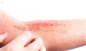 Image result for dermatitis contacta