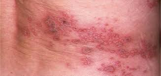 Remedio Natural Para El Herpes Zoster O Culebrilla