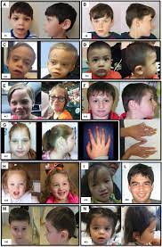 De Novo And Inherited Tcf20 Pathogenic Variants Are Associated With Intellectual Disability Dysmorphic Features Hypotonia And Neurological Impairments With Similarities To Smith Magenis Syndrome Genome Medicine Full Text