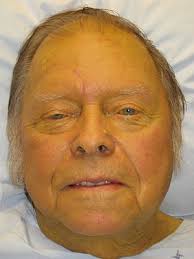 Penyakit sistemik akut yang disebabkan oleh virus yang disebut flavivirus. Jaundis Wikipedia Bahasa Indonesia Ensiklopedia Bebas