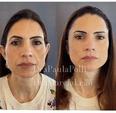 Harmmonica.orofacial