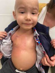 Fundraiser for Juan Manuel Aldape Muñoz by Peyi Soyinka-Airewele : Help 3  year old Caim Aldape Beat Liver Cancer