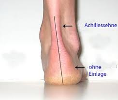 Ich habe seit dem kindesalter jedes jahr neue schuheinlagen, nur seit ca. Achillessehne Achillessehnenschmerz Achillodynie Ursachen Behandlung Therapie
