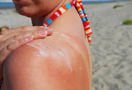Image result for Sunburn