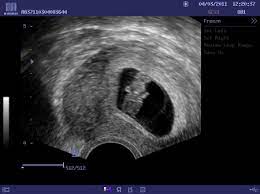 Get your local news from news channel 8, on your side for tampa bay, st. 8 Tyden Tehotenstvi Mudr Jarmila Halova Babyonline Cz