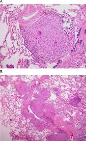 Terminology while the term has sometimes been used synonymously with cavitating pneumonia in some publications 2, not all ne. Hypersensitivity Pneumonitis A Review And Update Of Histologic Findings Journal Of Clinical Pathology