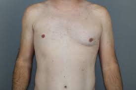 Surgical repair was based on this division. Before And After Galleries Polands Syndrome