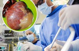 Ovarian cancer tends to present with a pelvic mass, so i've included a differential diagnosis for this. Ovarian Cyst Symptoms Types And Treatment