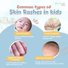 Image result for dermatitis contacta children