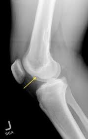 Image result for PCL Sulcus Test