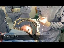 Image result for Thalamotomy