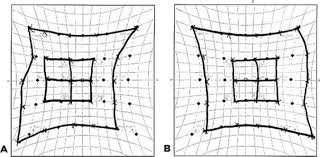 A Case Of Bilateral Fourth Nerve Palsy Associated With