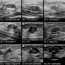 This test is often used when a change has been seen on a mammogram or when a change is felt. The Radiology Assistant Ultrasound Of The Breast