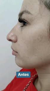 ✔️Rinomodelación , ✔️ Relleno de Mentón, 🔸Dra. Luisa Cedeño/Dr. Eddel  Rengel, 🔹Doctores en Medicina UDELAR 🩺 , ♦️Medicina Estética Regenerativa  Facial y Capilar ♦️, #rinomodelacion #rinoplastia ...