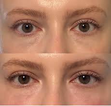 Polynucleotide treatment review: Can it improve dark circles?