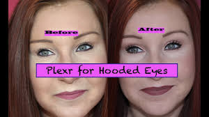 Check spelling or type a new query. Diary Of Plexr Treatment For Hooded Eyes Part 3 Results Non Surgical Blepharoplasty Beauty Treatments
