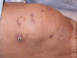 Image result for folliculitis symptoms