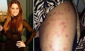 Laser hair removal was invented in the late 1990s, and has been used worldwide since. Horribly Scarred By Laser Hair Removal Daily Mail Online