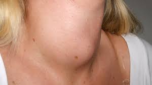 Removing all or part of your thyroid gland is an option if you have a large goiter that is uncomfortable or causes difficulty breathing or swallowing or, in some cases, if the goiter is. Goiter Causes Types And Treatment