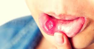 Check spelling or type a new query. Cara Menghilangkan Ulser Mulut Dengan Cepat Petua Dan Rawatan