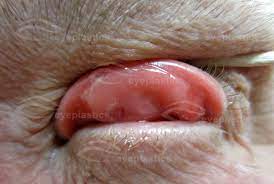 Maybe you would like to learn more about one of these? Floppy Eyelid Syndrome Eye Lid Laxity Ectropion Entropio Floppy Eyelid Laxity Trichiasis
