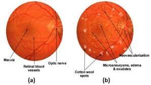 Which means that two clusters are formed, which means the classification is already done here? Diabetic Retinopathy Detection And Classification Using Capsule Networks Springerlink