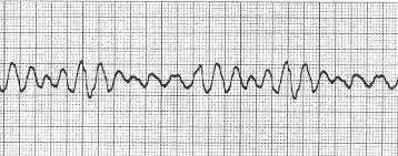 Image result for Ventricular Fibrillation