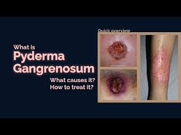 Image result for Pyoderma Gangrenosum