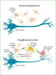 Motor Neuron Disease Http Www Stemcellshealthcare Com Treatable Diseases Motor Neuron Disease Mnd Disease Awareness Nursing Study Lou Gehrigs Disease