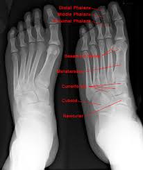 Ballet dancers may develop sesamoiditis. Foot X Ray Normal Findings Bone And Spine