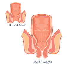 Image result for Rectal Prolapse