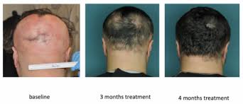 Its mostly noticable to the person treating. Fda Approved Drug Restores Hair In Patients With Alopecia Areata