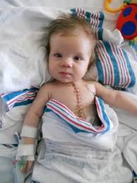 Open Heart Surgery Open Heart Surgery Heart Surgery Surgery