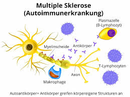 Die multiple sklerose (ms) ist eine chronische, nicht heilbare entzündliche erkrankung, bei der das eigene immunsystem nervenbahnen in gehirn und rückenmark schädigt. Multiple Sklerose Ms