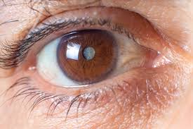 Image result for Cataract