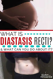 Check spelling or type a new query. What Is Diastasis Recti Plus How To Start Healing Kitchen Stewardship