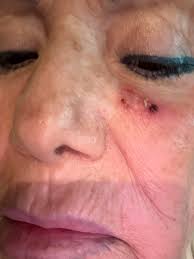 Does ivermectin help skin cancer?