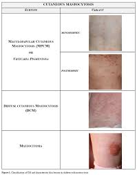 Image result for Urticaria pigmentosa children