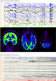 The role of hybrid FDG-PET/MRI