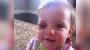 Daisy's rare eye cancer and the signs that could help others