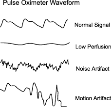 What is a pulse oximeter? Pulse Oximetry Springerlink