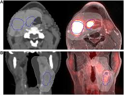 Head and neck tumor evaluation